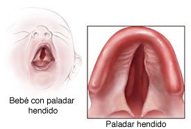 spanish_cleft_palate_small