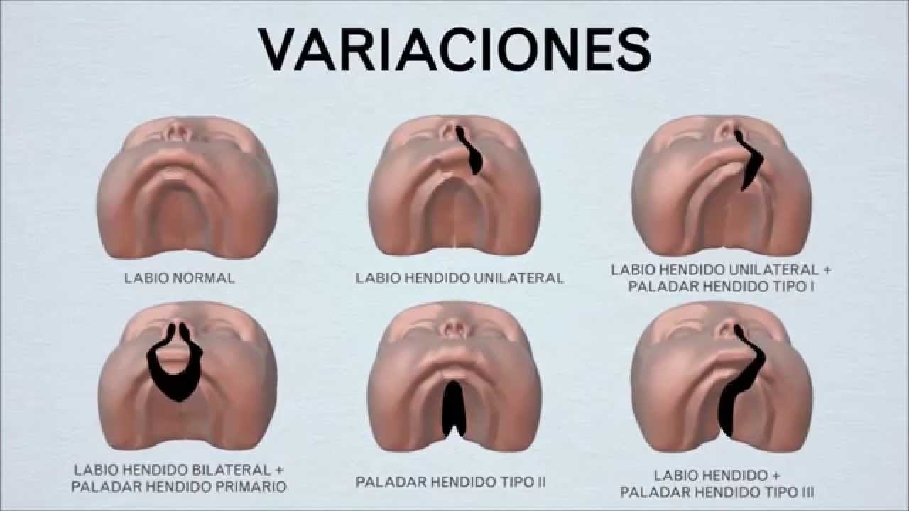 paladar-hendido
