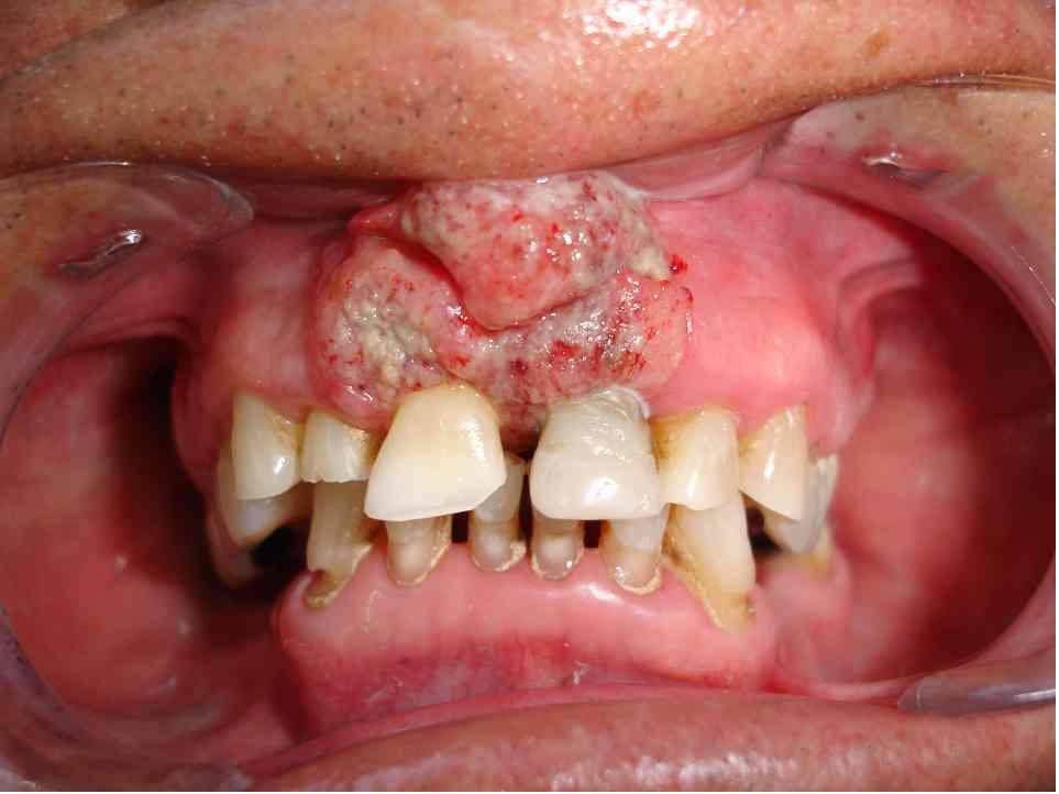 El cáncer bucal, grave problema de salud pública en México