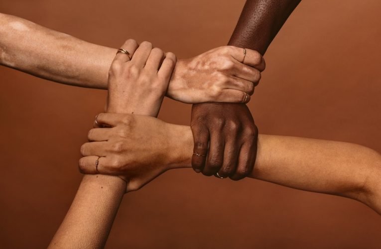 Día Mundial del vitíligo: urgente visibilizar y normalizar este padecimiento para evitar la discriminación y el bullying